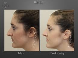 Learn about rhinoplasty costs & recovery time, and view nose job before and after photos from renowned manhattan plastic surgeon dr. Rhinoplasty New Orleans New Orleans Center For Aesthetics And Plastic Surgery