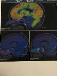 Maybe you would like to learn more about one of these? Kira S Pet Scan Results Are In And Making Dipg History Facebook