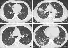 My guess would be some type of fungal infection or cancer. Comparison Of Chest Ct Findings Between Covid 19 Pneumonia And Other Types Of Viral Pneumonia A Two Center Retrospective Study Springerlink