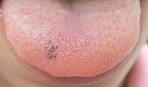 Image result for Macule