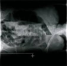 Image result for Adynamic Ileus