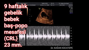 9 haftalik 2 aylik gebelik bebegin kalp atislari goruluyor crl bas popo mesafesi 23 milimetre youtube