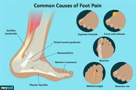 Image result for Foot Pain