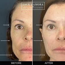 HA Filler results by @jamies_skinlab 💉We are loving the natural looking  result she achieved by bringing a youthful balance to the face. By  injecting the jawline, medial cheek and lateral cheek, Jamie
