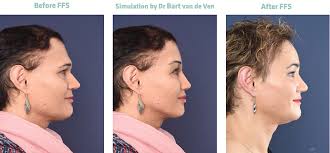 See yourself with a beard. Facial Feminization Surgery Get Your Own Picture Simulation For Facial Feminization Surgery 2pass Clinic