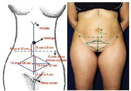 Rbcp Mini Abdominoplasty Associated With Liposuction And Lowering Of The Umbilical Scar Without Pedicular Detachment
