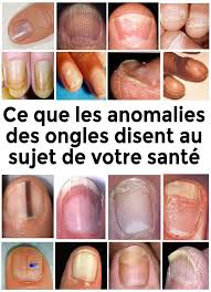 Ce Que Les Anomalies Des Ongles Disent Au Sujet De Votre Sante Sante Nutrition Nail Disorders Nutrition Healing