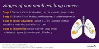 A family history of lung cancer may mean you are at a higher risk of. 5 Important Things To Know About Lung Cancer