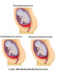 It occurs most commonly around 25 weeks of pregnancy. Abruptio Placentae Vs Placenta Previa Nclex Review