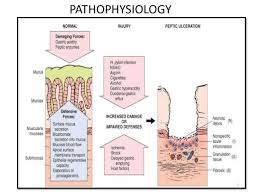 Pin By Val Logz On Surgery Peptic Ulcer Aspirin Surgery