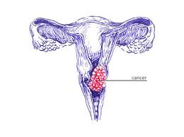 Maybe you would like to learn more about one of these? Cervical Cancer