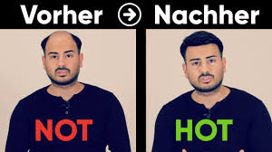 Möchtest du eine haartransplantation in stuttgart machen lassen? Transformation Volle Haare Ohne Haartransplantation Haarausfall By Jacob M