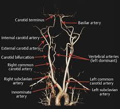 Internal carotid artery internal carotid arteries are major arteries of the head and neck that supply blood to the brain. 19 Vascular Abnormalities Of The Head And Neck Radiology Key