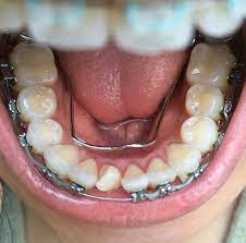 Braces Girlswithbraces Metalbraces Powerchain Braces Tips Orthodontics Braces Braces Girls