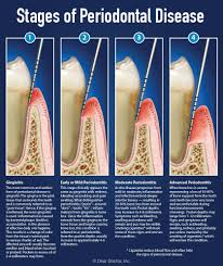 Check spelling or type a new query. Understanding Periodontal Pockets