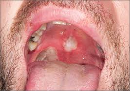 Image result for Mouth ulcers symptoms roof of the mouth