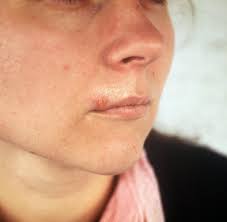 Viruserkrankung Lippenherpes Ist Unschon Und Nicht Immer Harmlos Welt