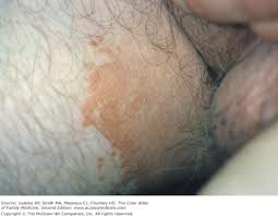 Image result for Erythrasma