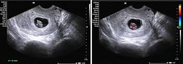 We had our first ultrasound and got to hear our sweet baby's heartbeat!! Early Ultrasound Diagnosis Of Conjoined Twins At Eight Weeks Of Pregnancy A Case Report