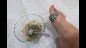 как лечить косточку на ноге в домашних условиях отзывы Effektivnyj Sposob Izbavitsya Ot Kostochki Na Nogah Youtube