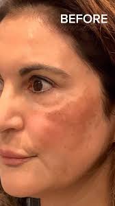 My favorite magic trick? Making melasma disappear! 🪄🎩🐰, This lovely  patient of mine dealt with significant melasma