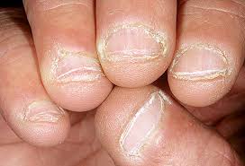 Image result for rippled nails