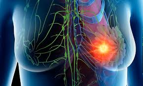 Image result for Breast Cancer Screening