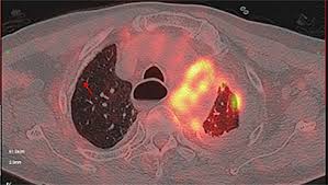 P16/cdkn2a homozygous deletion, advanced stage, and sarcomatoid histology were. Pulmonary Embolism With Malignant Pleural Mesothelioma Ott