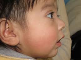 Orthodontic Airway Plate Treatment Program for Robin Sequence