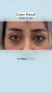 Natural, young, beautiful,, Dr. Hilmi, Eye surgeon, Baghdad, Iraq , Tel:  +9647724444010, Welcome To The Next LvL®️, #TopSurgeon, ‎#عملياتالتجميل  #اجفان#… #blepharoplasty #surgery #…, ...