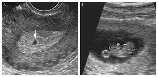 Image result for First Trimester Ultrasound