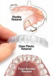 Retainers From 200 For Retention Of Straight Teeth In Kingston London