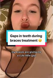 Getting braces is a process and trusting the process and your Ortho is key  🔑🦷✨ #braces #gaps #toothgap #bracestips #teethcare #teethtok #braceslife  #bracescheck #orthodontistsoftiktok