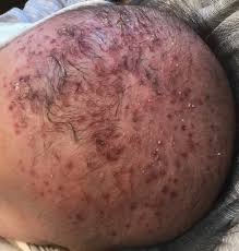 Infection with herpes simplex virus, commonly known as herpes, can be. Seborrhea Herpeticum Cutaneous Herpes Simplex Virus Infection Within Infantile Seborrheic Dermatitis Mdedge Dermatology