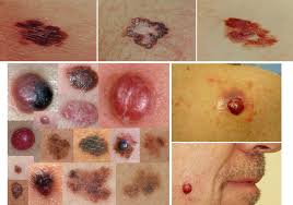 You can discuss your skin cancer symptoms with a specialist in the cutaneous oncology program at moffitt cancer center. What Is Skin Cancer South Coast Dermatology Cosmetic Center Blog