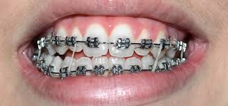 Other dental alterations are increased overjet, decreased overbite and posterior crossbite 18). How Braces Can Fix Speech Problems