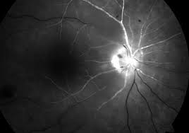 Every now and then there's a light in the darkness by taleah mcmahon. Central Retinal Artery Occlusion Wikipedia