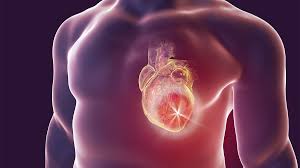 Myocarditis, also known as inflammatory cardiomyopathy, is inflammation of the heart muscle. The Rise Of A Rare Heart Condition The Well The Well
