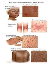 Image result for Atopic eczema atopic dermatitis