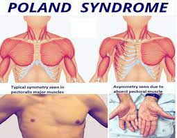 Poland's syndrome is a rare congenital condition classically characterized by partial or complete absence of chest muscles on one side of the body and usually webbing of the fingers of the hand on. Meddy Bear Poland Syndrome Facebook