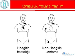 Lenf dokusunun habis tümörüne verilen genel bir isimdir. Hodgkin Lenfoma Prof Dr Fevzi Altunta Ankara Yldrm
