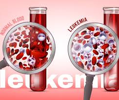 Il termine leucemia non indica in realtà un'unica malattia, ma un insieme di numerose forme che in prima battuta possono essere. Leucemia Cause Sintomi Epidemiologia