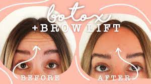 We did not find results for: Getting Botox Brow Lift Before After Vlog Youtube