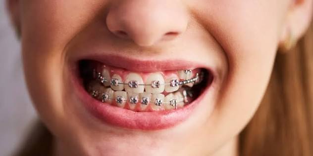 All About Braces: Types, Benefits & Treatment Tips