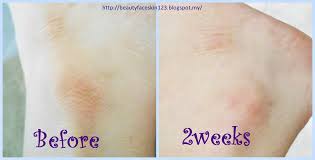Acne scars, stretch marks, blemishes, discolouration, or any other imperfections can hinder one from achieving the perfect beauty. Great Skinandlife Review On Bio Oil