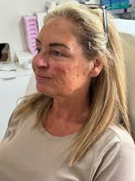When Vicki came to me she hadn't had any aesthetic treatments, this is her  tweakment journey. — Samantha Carron Aesthetics Ltd