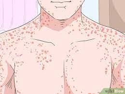 Along with ebola virus, marburg virus many of the early symptoms of marburg haemorrhagic fever are similar to those of other. How To Recognize Marburg Hemorrhagic Fever Symptoms 13 Steps