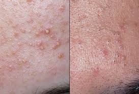 Jun 15, 2021 · efek samping baby oil untuk wajah yang kedua adalah dapat menimbulkan kemunculan jerawat. Petua Mudah Hilangkan Jerawat Pasir Di Muka Ramai Yang Tak Tahu Boleh Buat Di Rumah Jer