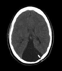 Direct Cystoperitoneal Shunt Pacific Adult Hydrocephalus Center