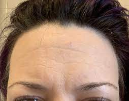 Because the muscles are unable to contract, they instead relax, resulting in a smoother appearance on the surface. Botox Advice Please Mumsnet